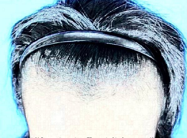 大連發(fā)際線種植費(fèi)用要多少?大連發(fā)際線種植醫(yī)院推薦