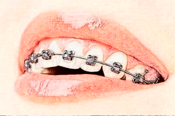 淮北頜面正畸價(jià)格表?頜面正畸哪個(gè)醫(yī)院好