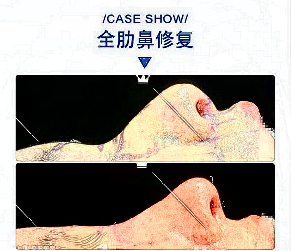 華西醫(yī)院卿勇全肋鼻修復(fù)案例圖片（來(lái)源知乎）