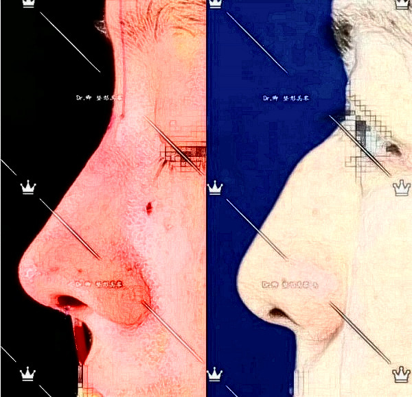 華西醫(yī)院卿勇駝峰鼻矯正案例圖片（來(lái)源知乎）