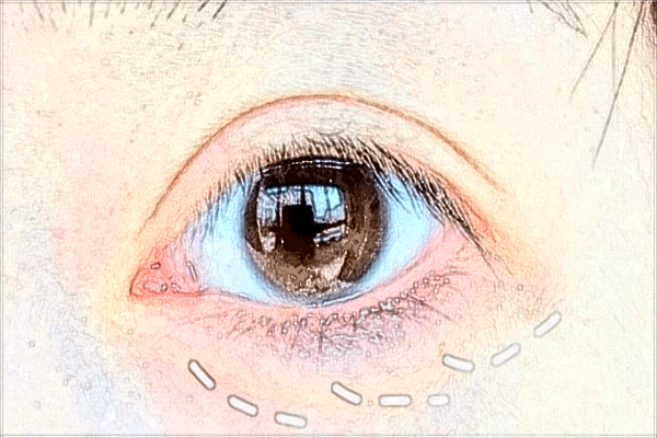 保定華美做雙眼皮哪個(gè)醫(yī)生好【附案例】