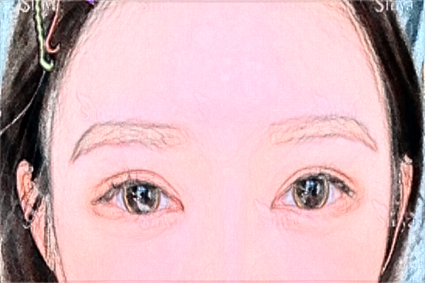 2024割雙眼皮價(jià)目表_深圳嘉美怎么樣