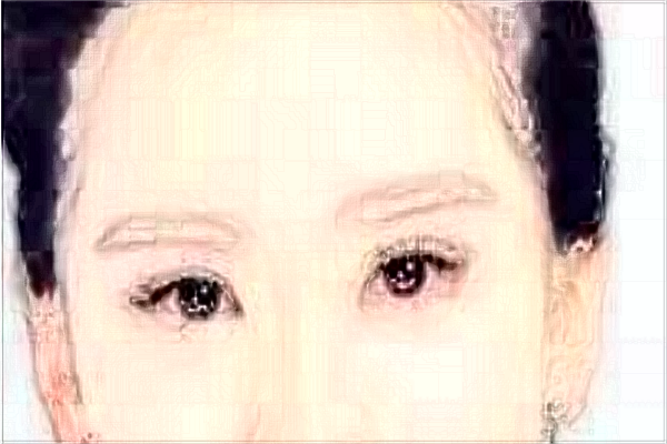 割雙眼皮是全麻還是局部麻醉?割雙眼皮是*的嗎?