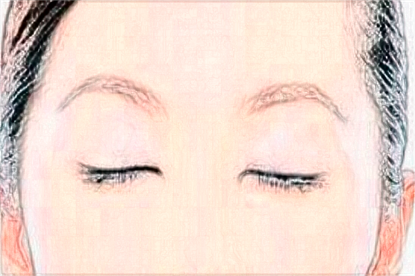 2024割雙眼皮價目表公布_割雙眼皮大概多久能恢復(fù)正常