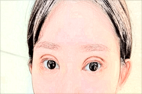 割雙眼皮要注意的事項(xiàng)?割雙眼皮要恢復(fù)多少天?