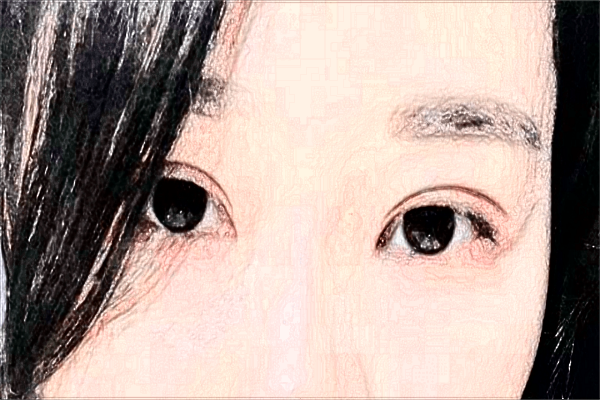 割雙眼皮打麻藥疼嗎?割雙眼皮打麻藥打哪里?