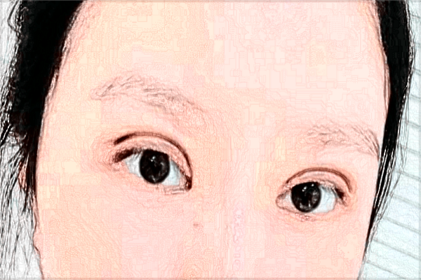 割雙眼皮打麻藥疼嗎?割雙眼皮打麻藥打哪里?