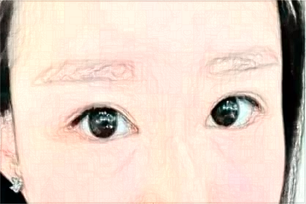 割雙眼皮會留疤痕不?割雙眼皮會導(dǎo)致視力下降嗎?