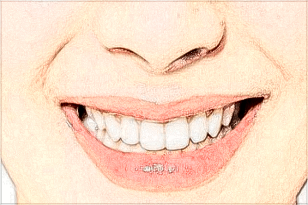 種植牙多少錢一顆_種植牙價格一覽表