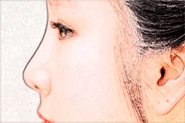 硅膠豐太陽穴效果怎么樣?2024硅膠豐太陽穴價格表