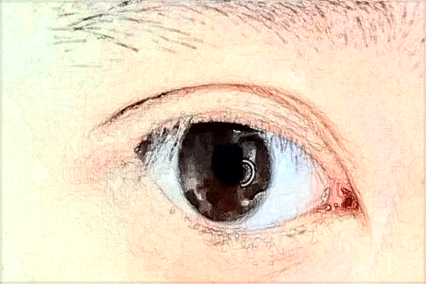 2024吉林大學(xué)第二醫(yī)院做上眼瞼提肌術(shù)多少錢