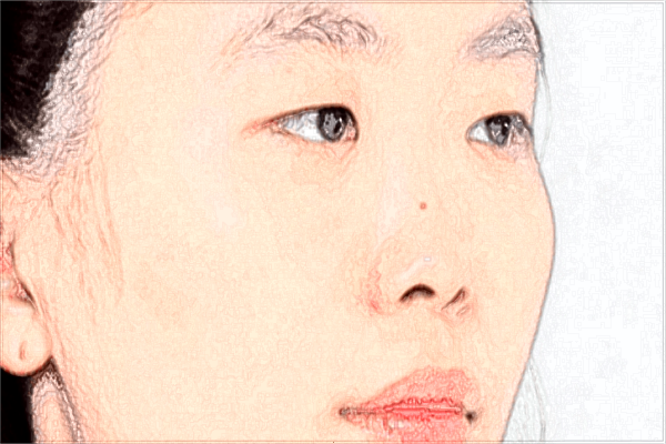 2024鄭大一附院激光去紅血絲收費價格怎么樣