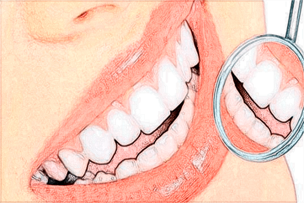 2024沈陽二院補(bǔ)牙價(jià)目表_補(bǔ)牙后需要做牙套嗎