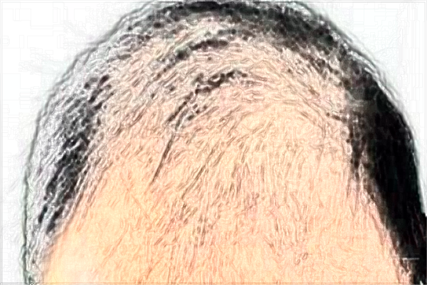 2024河北醫(yī)科大學(xué)第三醫(yī)院植發(fā)怎么樣?植發(fā)能維持多久?