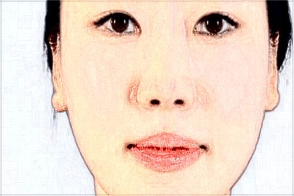 廣州海峽拉皮可以祛除法令紋嗎?拉皮價(jià)格貴嗎?