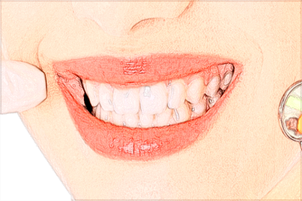 北京天壇醫(yī)院牙齒矯正怎么樣【牙齒矯正案例】