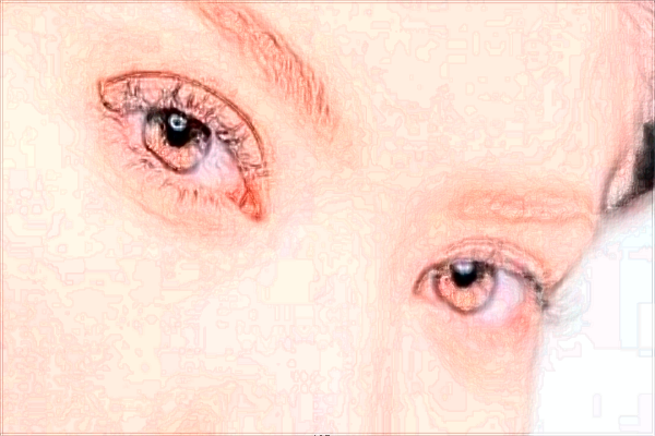 北京藝美自體脂肪豐臥蠶怎么樣【附自體脂肪豐臥蠶案例】