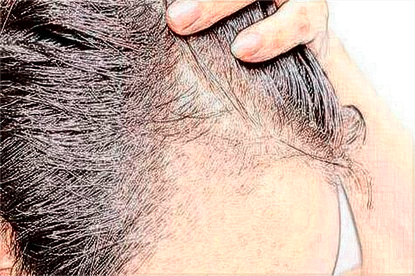 種植發(fā)際線一般多少錢?種植發(fā)際線多久能長(zhǎng)起來