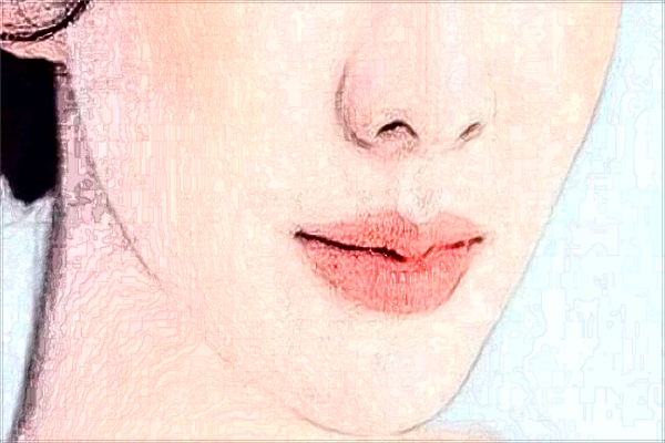 玻尿酸豐面頰有危害嗎?玻尿酸豐面頰多久吸收?