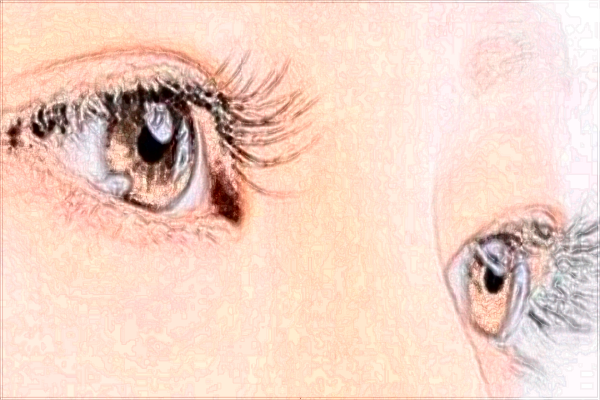 北京潤美玉之光開眼角怎么樣【附開眼角案例】