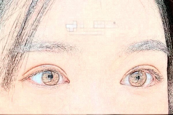 2024上海九院李茅割雙眼皮案例恢復(fù)過程分享