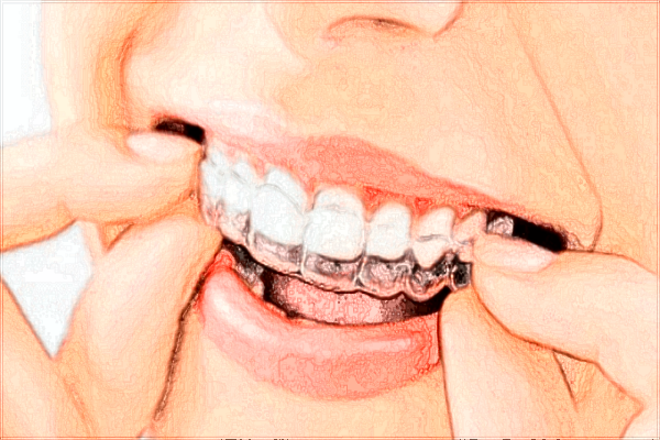 北京大學(xué)口腔醫(yī)院種植牙價格表_種植牙需要住院嗎