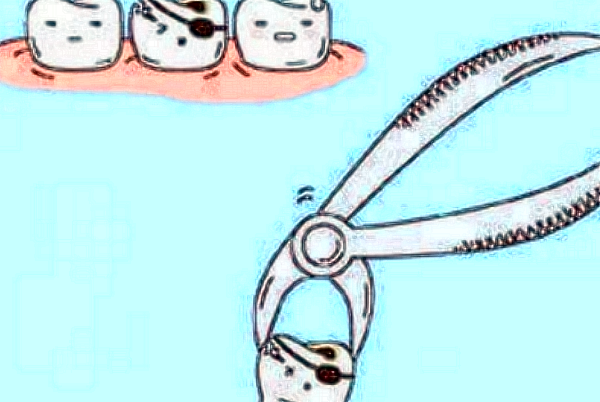 2024北京地壇醫(yī)院口腔科拔牙怎么樣_拔牙后的注意事項