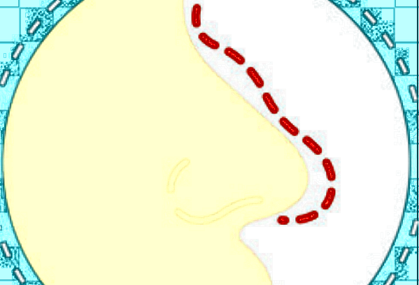 膨體隆鼻要多長(zhǎng)時(shí)間?膨體隆鼻要住院?jiǎn)?