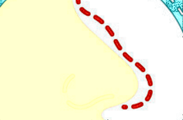 膨體隆鼻多少費用?膨體隆鼻要忌口多長時間?