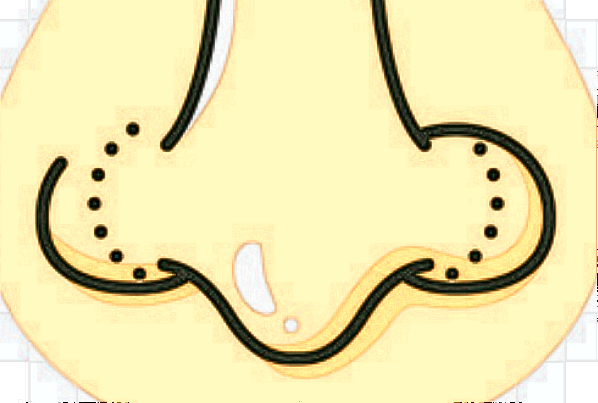 膨體隆鼻需要墊鼻尖嗎?膨體隆鼻需要恢復(fù)多久可以自然?