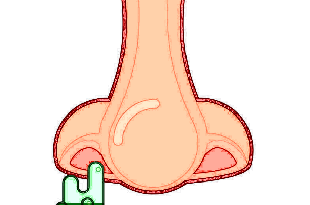 膨體隆鼻需要耳軟骨嗎?膨體隆鼻需要開刀嗎?