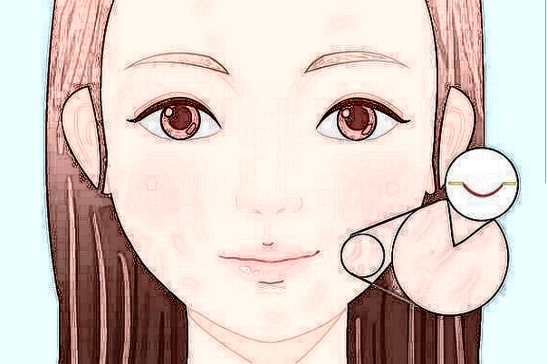 寧波二院去疤痕怎么樣?寧波二院去疤痕收費標(biāo)準(zhǔn)