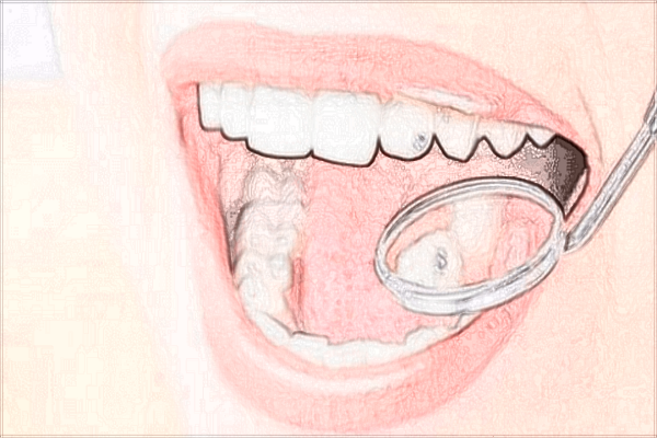 2024四川省人民醫(yī)院口腔科補(bǔ)牙多少錢_價(jià)格表+案例