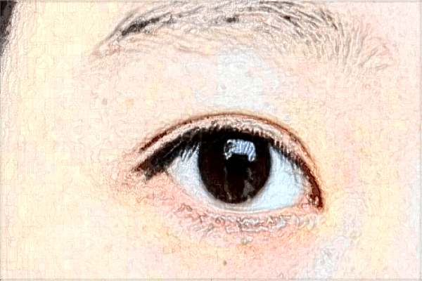 2024成都格萊麗做雙眼皮價格?醫(yī)生雙眼皮案例