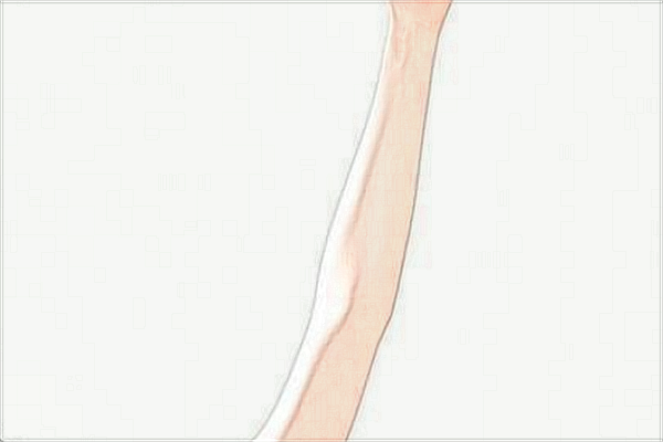 四川省人民醫(yī)院去疤痕價(jià)目表(價(jià)格表)怎么樣