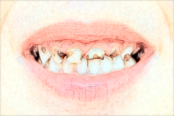 廈門(mén)市第—醫(yī)院牙科種植牙找哪個(gè)醫(yī)生?2024收費(fèi)價(jià)格