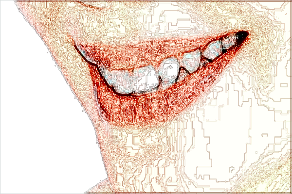 河北省口腔醫(yī)院全瓷貼面怎么樣_全瓷貼面對(duì)牙齒傷害大嗎