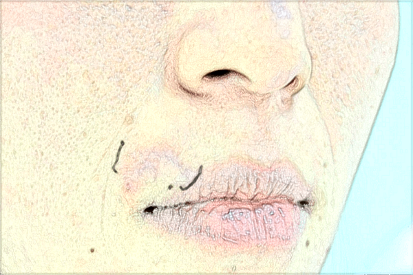 河科大二附院激光祛斑好嗎?激光祛斑手術案例