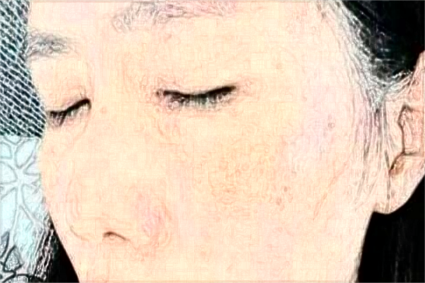 河科大二附院激光祛斑好嗎?激光祛斑手術案例