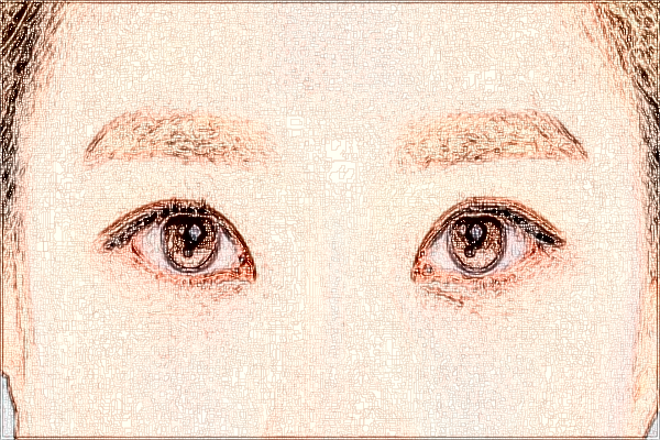 2024浙江省中醫(yī)院做眼袋醫(yī)生技術(shù)怎么樣【做眼袋案例】