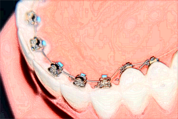 北大口腔醫(yī)院植牙醫(yī)生名單_附植牙案例