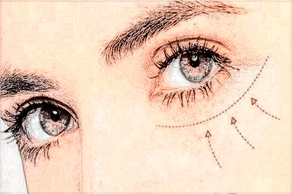 2024西安二院割眼袋價格割眼袋能保持幾年