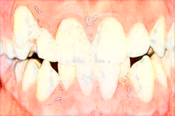 2024寧波二院牙齒矯正價(jià)格?牙齒矯正需要多長(zhǎng)的時(shí)間