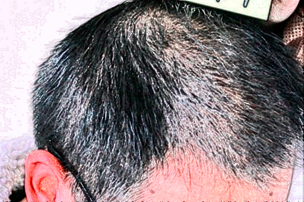 廣州華美植發(fā)靠譜嗎_怎么樣