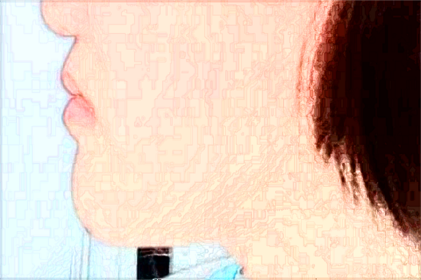 2024寧波市第一醫(yī)院去疤怎么樣_案例+價(jià)格