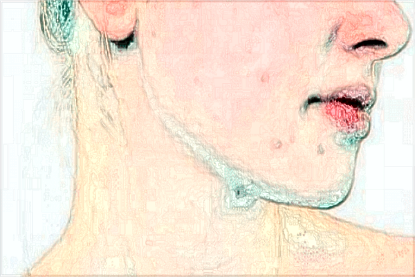 南昌大學(xué)第二附屬醫(yī)院激光祛斑怎么樣?激光祛斑的恢復(fù)期