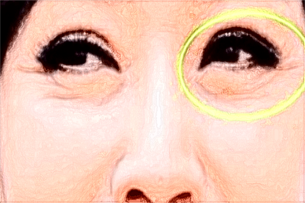 南昌大學(xué)第二附屬醫(yī)院激光祛斑怎么樣?激光祛斑的恢復(fù)期