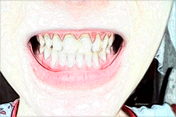 河北醫(yī)科大學(xué)口腔醫(yī)院隱形牙套多少錢_隱形牙套的矯正原理