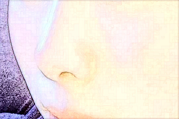 2024常州市第一人民醫(yī)院激光去色素沉重做的好嗎【案例分享】