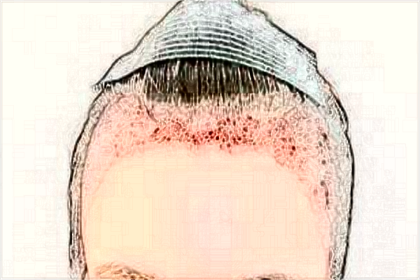 2024常州市第一人民醫(yī)院植發(fā)價目表(價格表)怎么樣